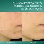 Acne/Pimple, Face Care, Serums, Oil, Skin, Skin Treatment, Treatment, Japan Mart